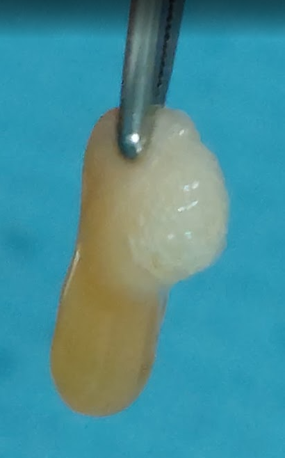 Tratamientos de cirugía bucodental en clínica dental