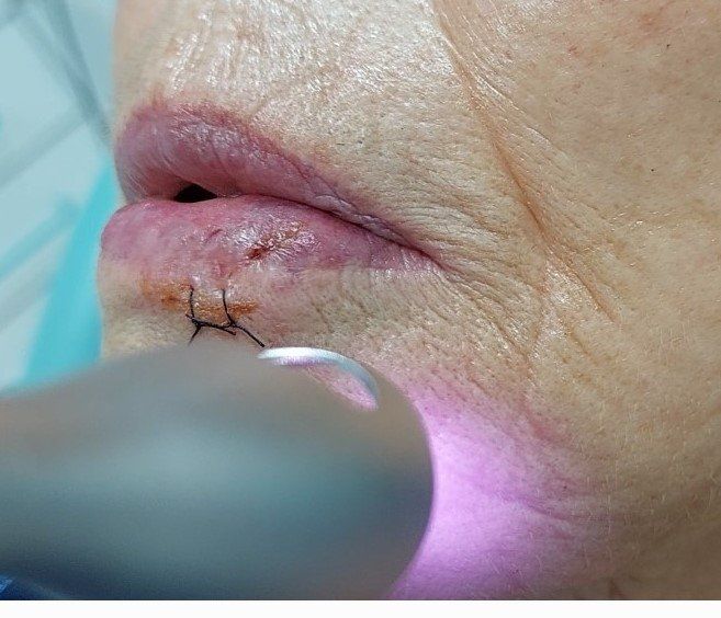 Tratamiento dental con laserterapia en clínica odontológica