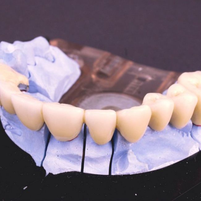 Implantes dentales