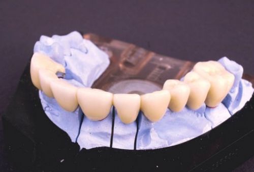 Implantes dentales