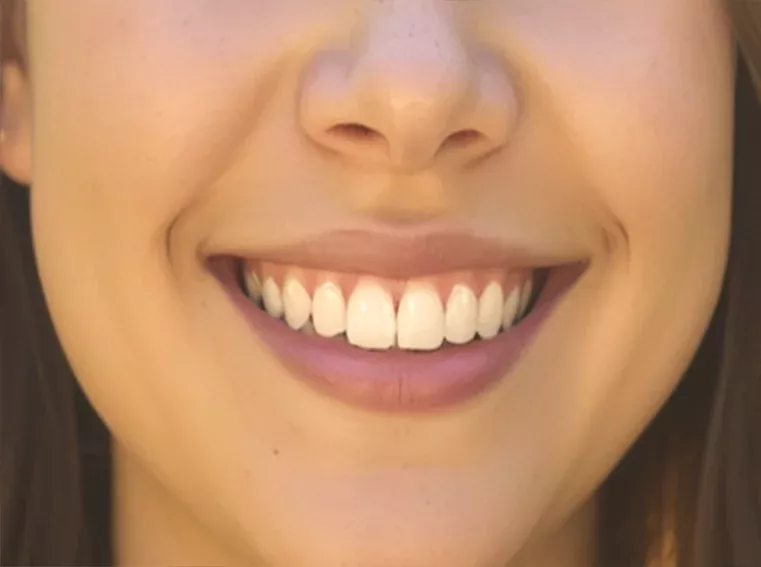 Tratamientos de odontología estética para mejorar la sonrisa
