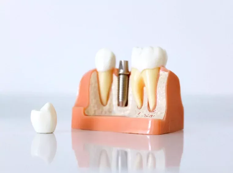 Tratamiento de implantes dentales para recuperar piezas dentales